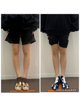 なおちゃん整骨院 整体院/O脚改善に「O脚矯正」