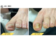 ふっとけ庵/肥厚爪ケア