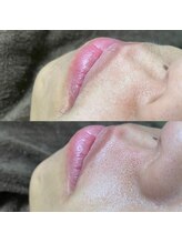 ナチュウル(Natulu)/シルク糸脱毛で口周りの産毛処理