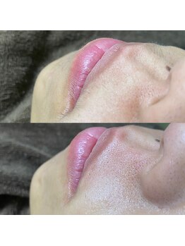 ナチュウル(Natulu)/シルク糸脱毛で口周りの産毛処理