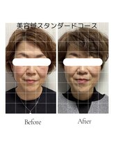 サロン ド ハリッシュ(Salon de HARISH)/初めての美容鍼