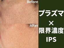 ポンディシェリ(Pondicherry)の雰囲気（黒ずみ、毛穴の開き、凸凹にも◎）