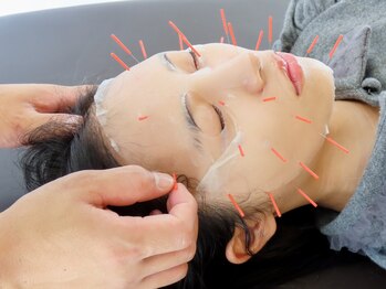 Drハリー 新宿の写真/【二重あご・頬のたるみを徹底改善!!】美容鍼で感動の小顔フェイスラインを実現☆リピーターの方も多数◎