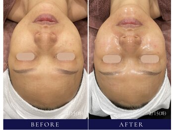 エムケーサロン(MK salon)/#スーパージェクション