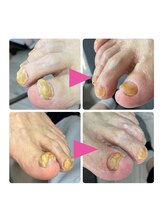 ナチュエイド/高齢者の厚い爪ケア