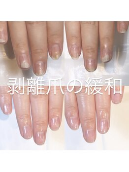 キュア(Cure.)/3ヶ月で剥離爪のお悩み解消