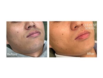 スタンド(STAND)/髭脱毛