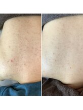 エステティックサロン S/4回目背中トリートメント