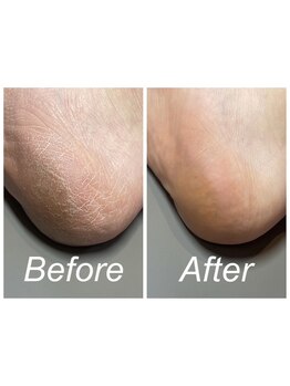 角質ケアができるサロン