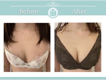 美人バスト 静岡店/バストアップ症例