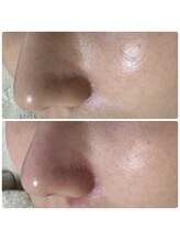 サラン(SALON)/鼻　ビフォーアフター
