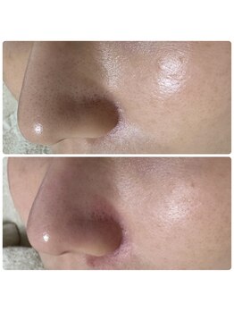 サラン(SALON)/鼻 ビフォーアフター