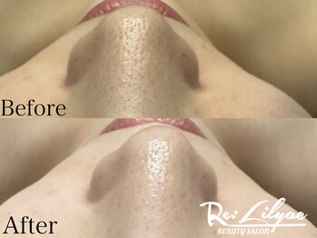 リリアック(Re:Lilyac)/Re:ilyac#肌質改善