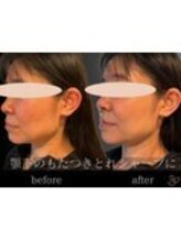 チョコバリ 錦糸町店(chocobari)/小顔×リフトアップ(美容鍼)30代