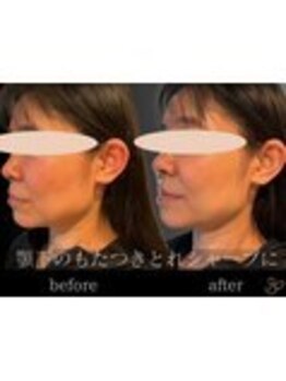 チョコバリ 錦糸町店(chocobari)/小顔×リフトアップ(美容鍼)30代