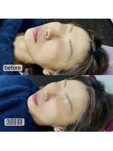 トゥインクル(Twinkle)/気になるほうれい線も！