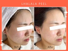 ハノハノ 八代店(HANO HANO)/韓国肌管理ララピール☆