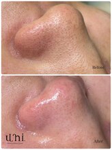 ユニ(uni.)/毛穴エクストラクション症例