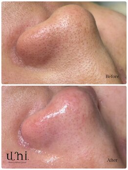 ユニ(uni.)/毛穴エクストラクション症例