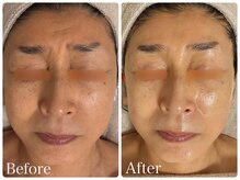 ロイヤル(ROYAL)/たるみ/シワ改善症例