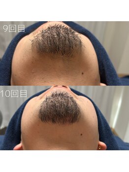 カナウ(KANAU)/ヒゲ脱毛（20代前半男性）