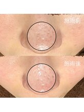 エクラ バイ シャンリィ(eclat by shanLy)/毛穴洗浄