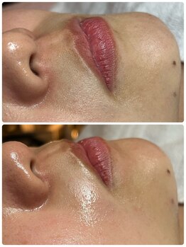 スパークル/毛穴/フェイシャル/毛穴洗浄