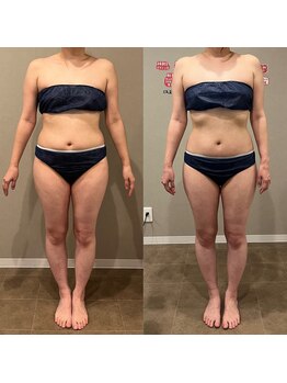 タイコボディラボ 桜山店(TAICO BODY LABO)/フォースカッターでくびれ