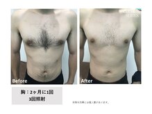 スプレール 水戸店/メンズ脱毛