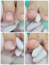 巻き爪補正店 西宮北口店/巻き爪　陥入爪