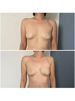 モア(moa)/エステ/バスト/40代/授乳後ママ