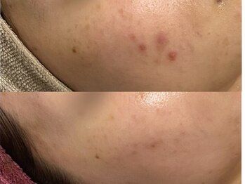 ホーミー(Homie)/ニキビ改善、赤みニキビ改善