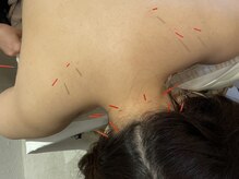 ストリ(STRI)/肩こりにお悩みの方に