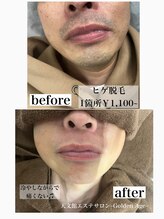 ゴールデンエイジ(Golden Age)/安心都度払いのメンズ脱毛♪♪