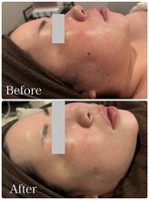 なごみ/最新美容◆プラズマフェイシャル