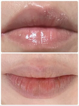 だれでもエステ 北浜店/ＬＥＭＥＬＬＡルメラ黒ずみケア