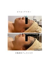 オル(orl.)/肌質改善フェイシャル