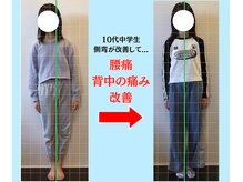 ソヴァール(SAUVEUR)/14歳中学生の側弯