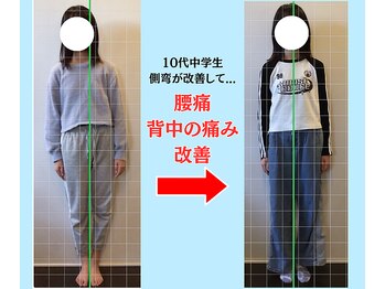 ソヴァール(SAUVEUR)/14歳中学生の側弯