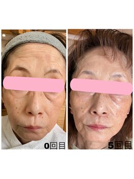 エクスクラメーションマーク(!!!)/リフトアップ★