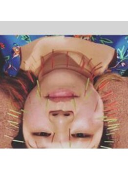 ルディア 堂島店(ledia)/大阪美容鍼 タレントやしろ優様