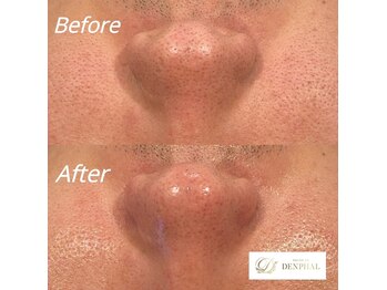 サロン ド デンファレ(salon de denphal)/ハイドラフェイシャル～美白～