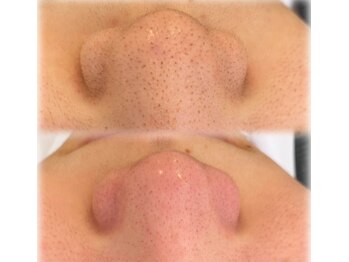 ウミ(Ummi)/毛穴エクストラクション