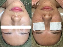 イベリス(Iberis)/ハーブピーリング/トーンアップ