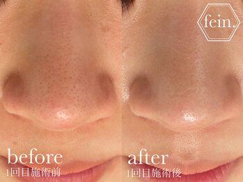 フェイン 青山店(fein.)/毛穴洗浄!ハーブピーリング!