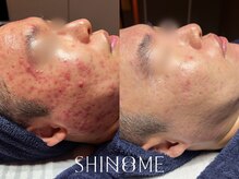 シノノメ(SHINONOME)/*長年の赤みケア