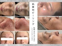 エクラ(eclat)の雰囲気（お悩み別ピーリング/肌質改善お任せください！）