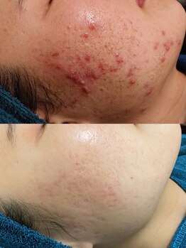 ソリッジ肌管理室/毛穴・ニキビケア