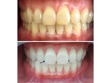 モンシェリ 広島店(Mon Cheri)/ホワイトニングBefore→After