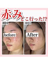 アルムダアクア 天王寺店(Aleumda AQUA)/ハーブピーリング/大阪/天王寺